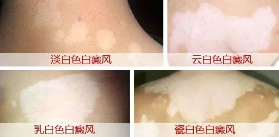 广州肤康皮肤病医院